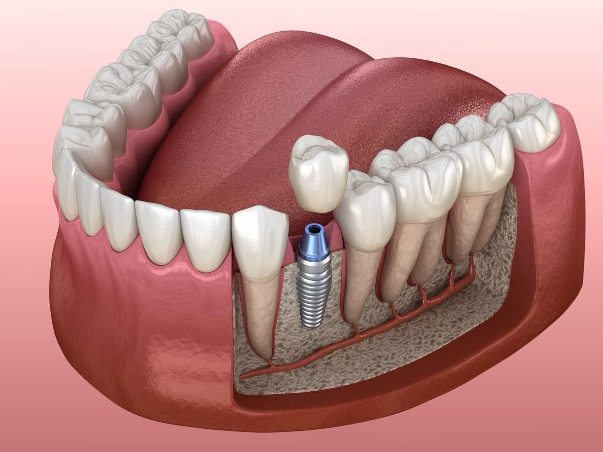 X-ray showing implant integration with jaw bone